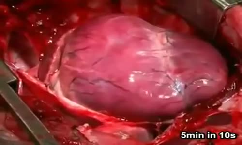 Açık Kalp Ameliyatı 