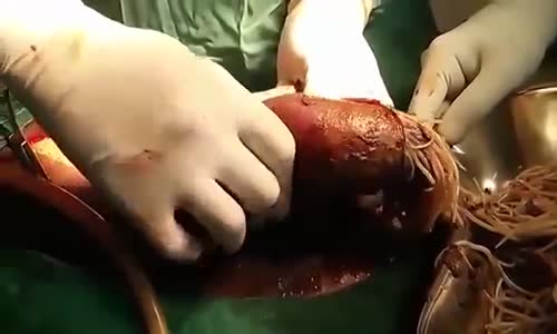 Ameliyat Görüntüleri Bağırsak Parazitleri