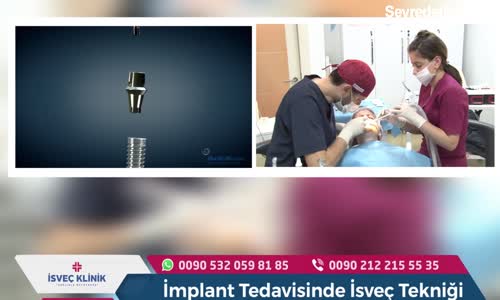 İmplant Tedavisinde İsveç Tekniği