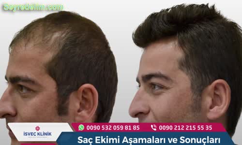 Saç Ekimi Aşamaları ve Sonuçları