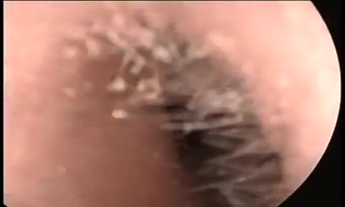 Gerçek Anlamda Kulak Zarı Patlaması