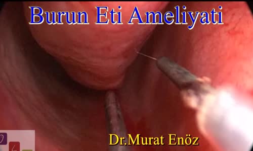 Burun Eti Ameliyatı