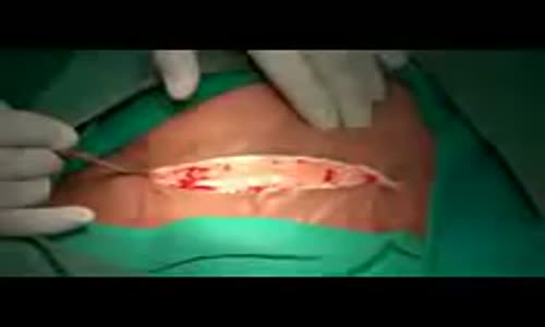 Sezeryan Doğum Videosu 