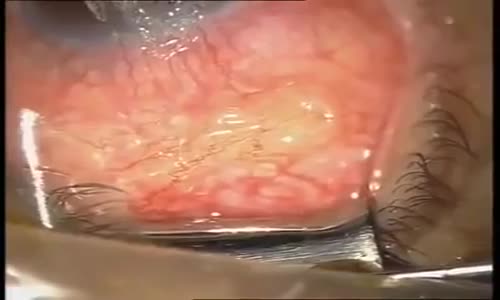 Ameliyatta Solucanı Gözünden Çekti