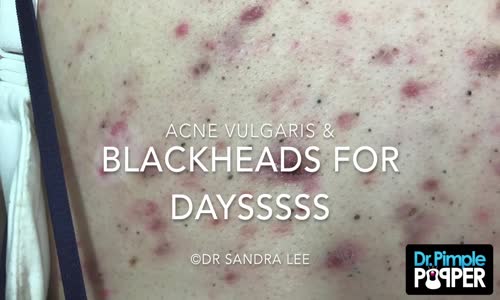 15 Dakika Boyunca Siyah Nokta Temizleyen Doktordan İzlemeyi Sevenlere Hipnoz Etkili Video