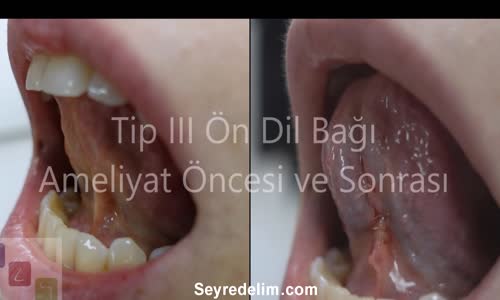 Tip III Ön Ön Dil Bağı - Ameliyat Öncesi ve Sonrası