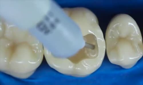 Diş dolgusunun nasıl yapıldığını merakmı ediyorsunuz?