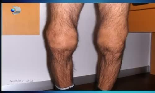 Tepkisel Eklem İltihabı Nedir