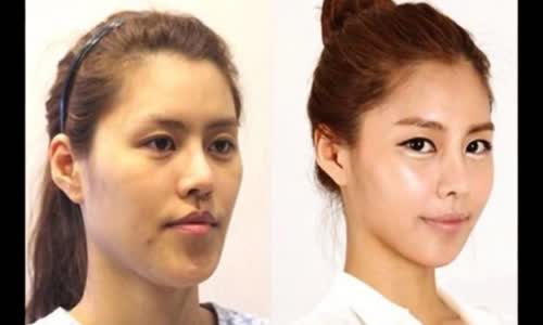 Korelilerin Estetik Ameliyatı Öncesi Ve Sonrası 