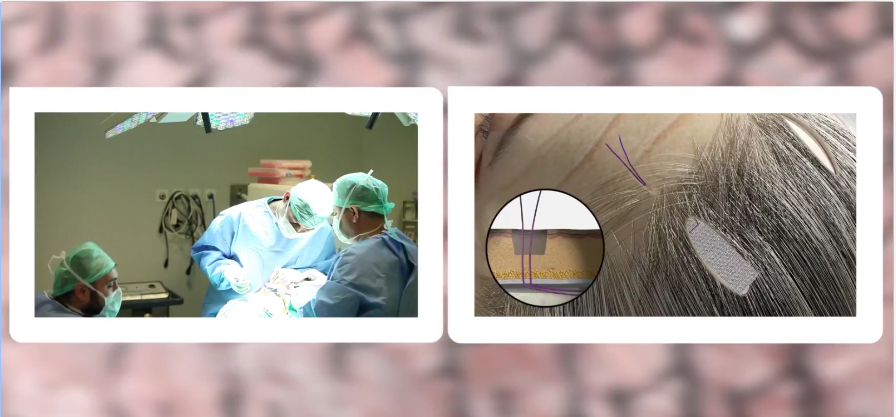 Kaş Kaldırma ( Şakak) Germe Estetiği 2017