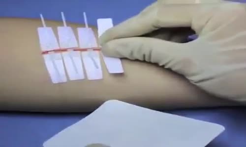 Dikişsiz Yaraları İyileştirme Bandı