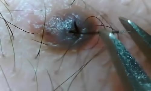 İltihap Kapmış Kıl Dönmesi Nasıl Çekilir