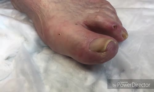 Tırnak Batması Ameliyatı Part 1