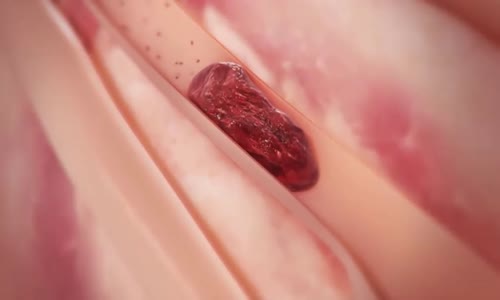 Damar Tıkanıklığı Tedavisinde Gelinen Son Nokta