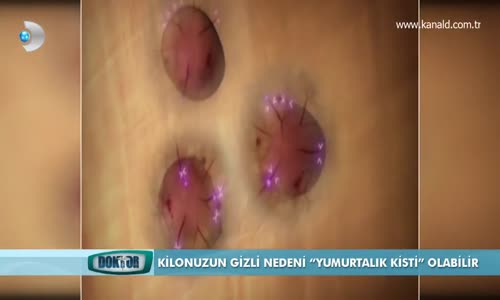 Yumurtalık Kisti ve Tedavi Yöntemleri