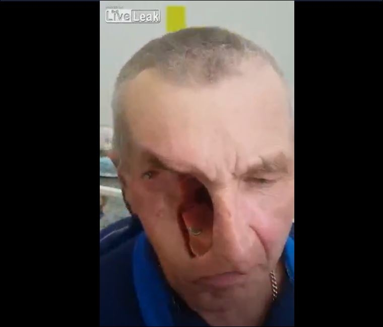 Yüzü Protez Olan Adam