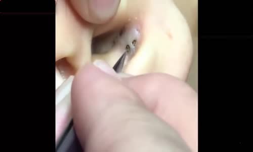 Kulakta Dev Siyah Nokta Temizliği