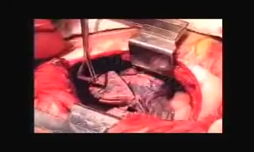 Akciğer Kanserli Hasta Canlı Ameliyat Video