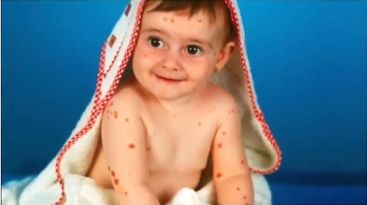 500 Doğum Lekesi Olan Genç Kız Yıllarca Aşağılandı. Ama Onu Şimdi Görmelisiniz