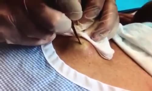 Adamın Sırtından Çıkan Şeye İnanamayacaksınız 