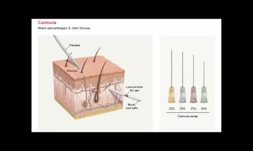 Kanül İle Modelis Uygulaması