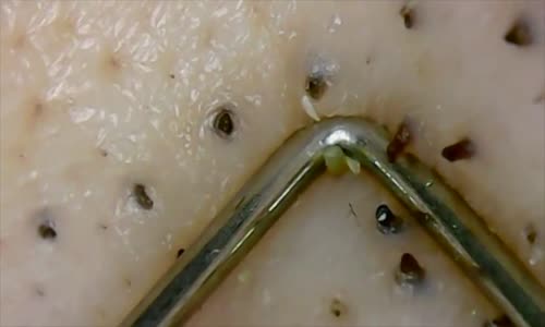 Siyah Nokta Temizleme