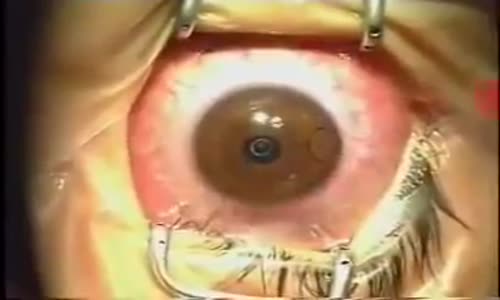 Göz Ameliyatı 