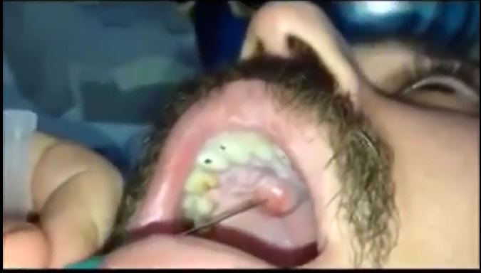 Adamın Damağından Çıkanları Görünce Çok Şaşıracaksınız