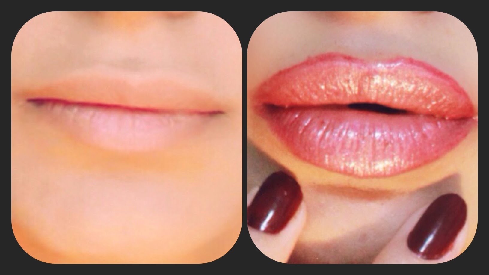 Dudak Dolgunlaştırma