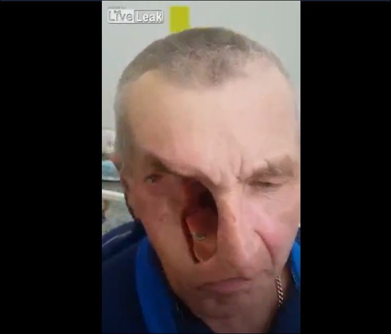 Yüzü Protez Olan Adam