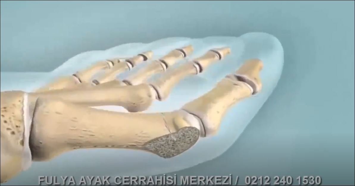 Halluks Valgus Tedavi Yöntemleri Nelerdir