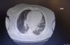 Korona Virüse Yakalanan Hastaların Ciğerlerindeki Dehşet Veren Görüntü