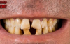 Dişlerinizi Bembeyaz ve Güçlü Yapacak 5 Basit Yöntem 