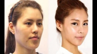 Korelilerin Estetik Ameliyatı Öncesi Ve Sonrası 