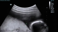 Ultrasonda Rockçı Olacağını Belli Eden Bebek
