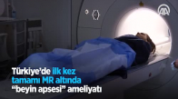 Türkiye'de İlk Kez Tamamı MR Altında Beyin Apsesi Ameliyatı